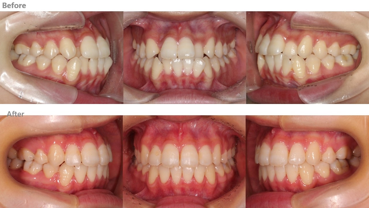 左右4本抜歯症例 左右4本抜歯症例