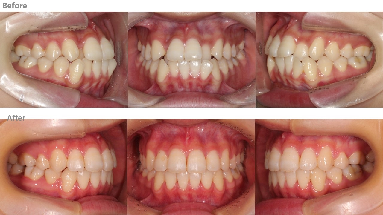 左右4本抜歯症例