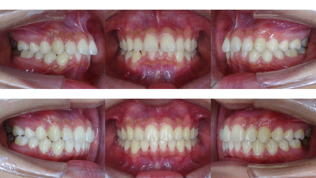 叢生(乱ぐい歯)をインビザラインで改善した症例 叢生(乱ぐい歯)をインビザラインで改善した症例