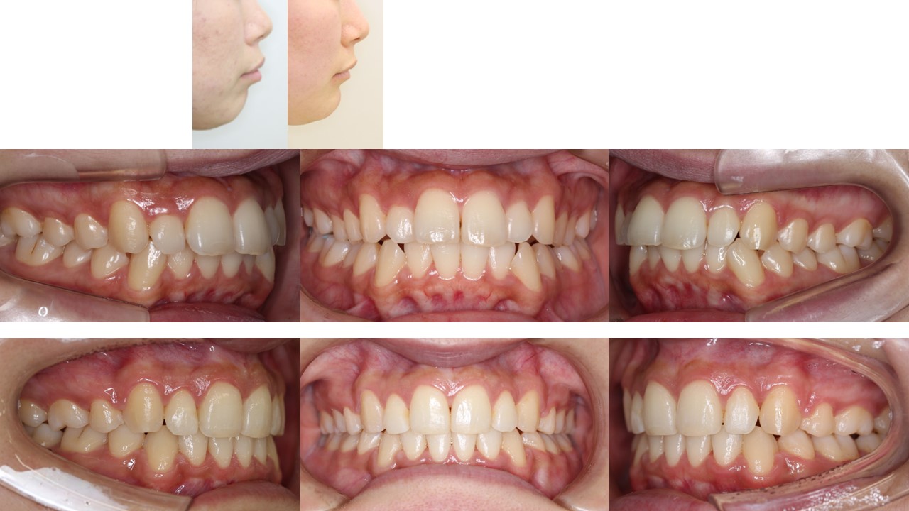左右4本抜歯症例 左右4本抜歯症例
