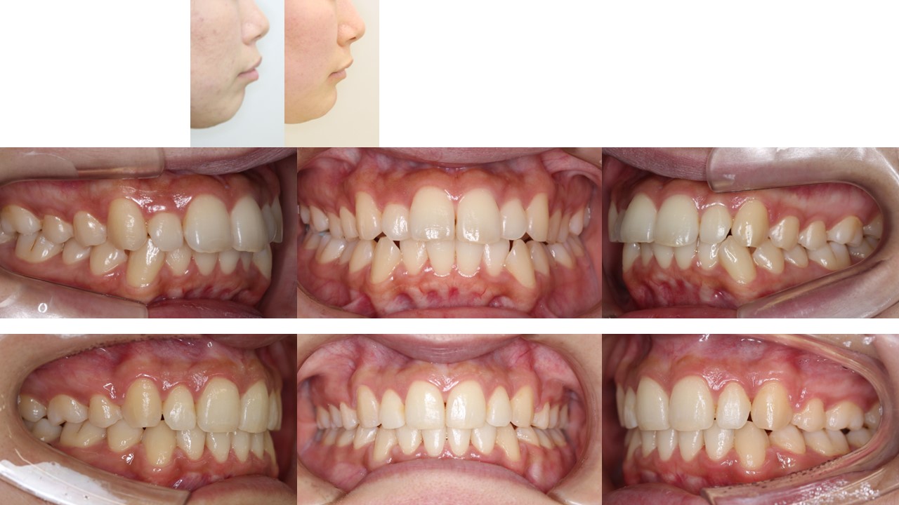 左右4本抜歯症例