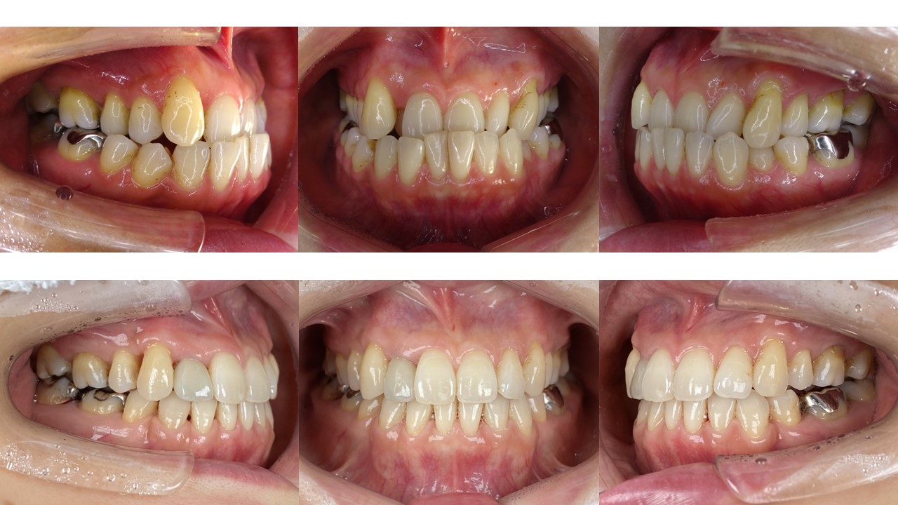 上右側、下左右抜歯症例 上右側、下左右抜歯症例