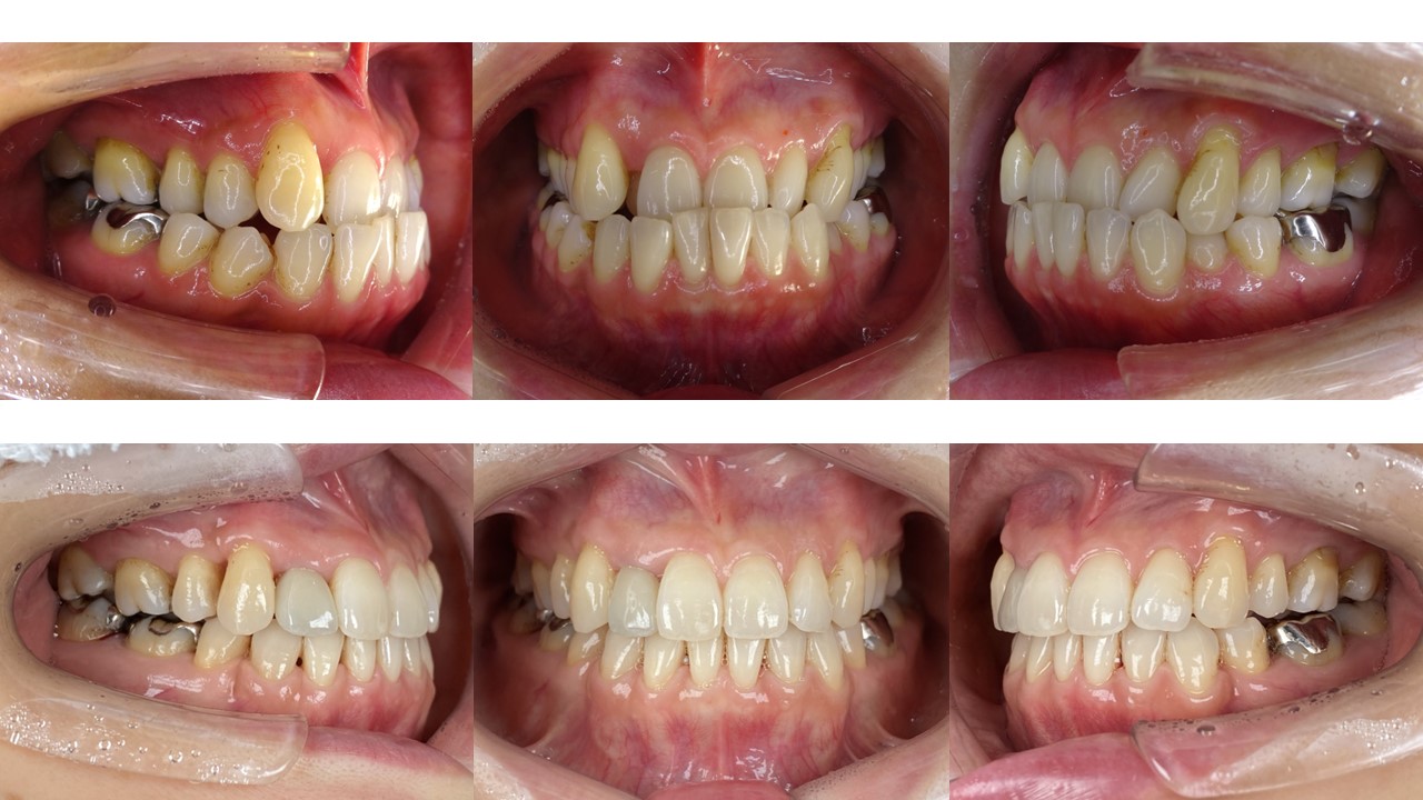 上右側、下左右抜歯症例