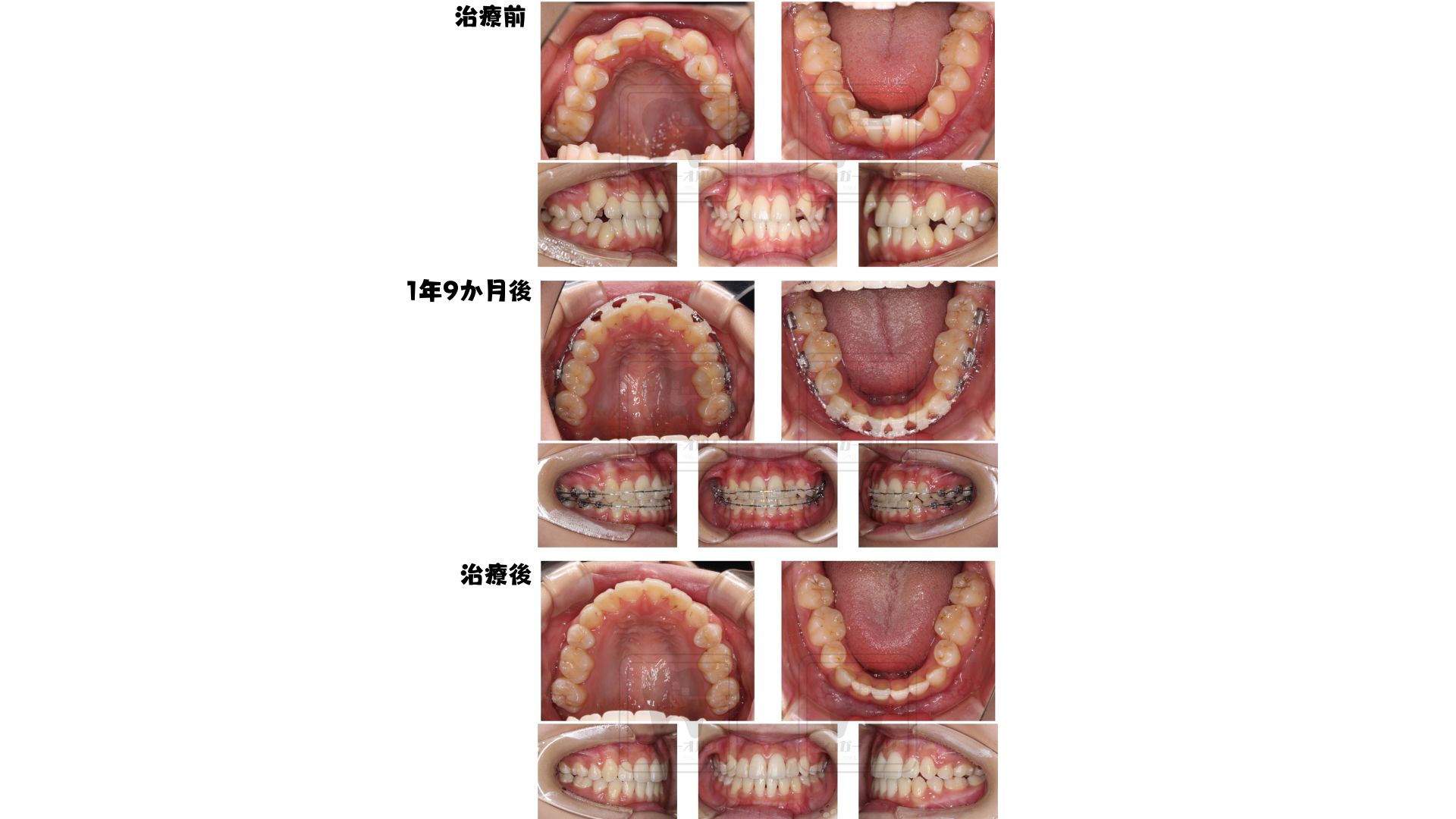 表側ワイヤー矯正（抜歯症例）