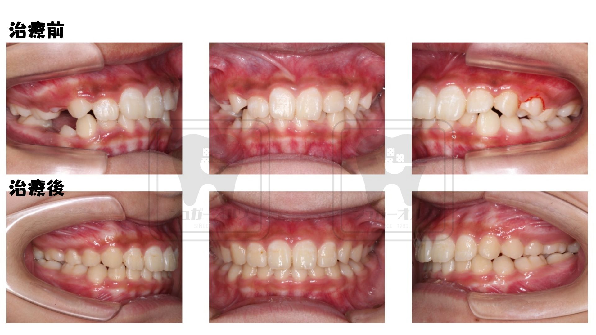 表側ワイヤー(下顎第二小臼歯先天性欠如歯)