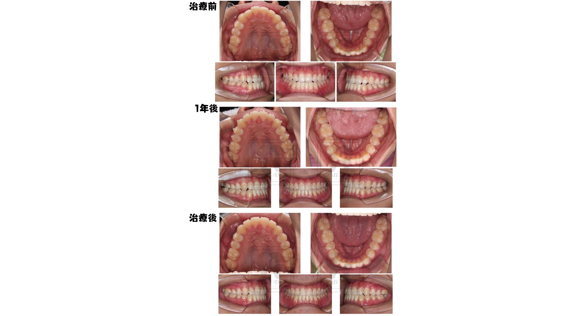 インビザライン非抜歯症例