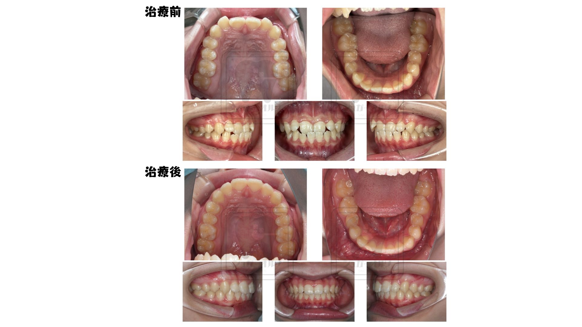 インビザライン　過剰歯抜歯症例