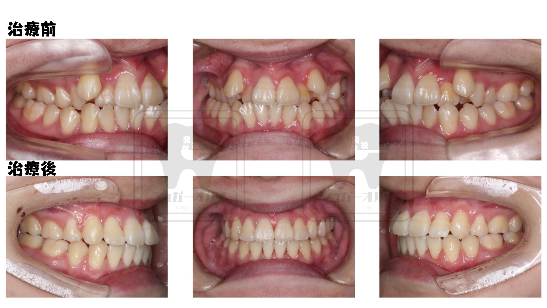 表側ワイヤー矯正（抜歯症例）
