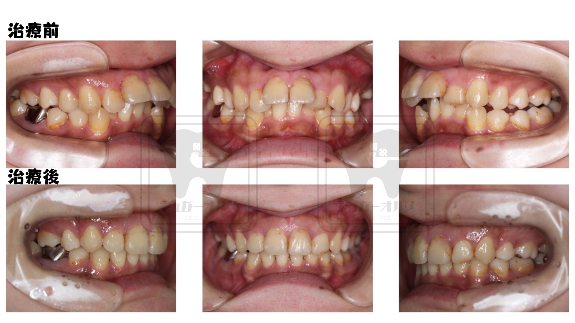 表側ワイヤー矯正（抜歯症例）