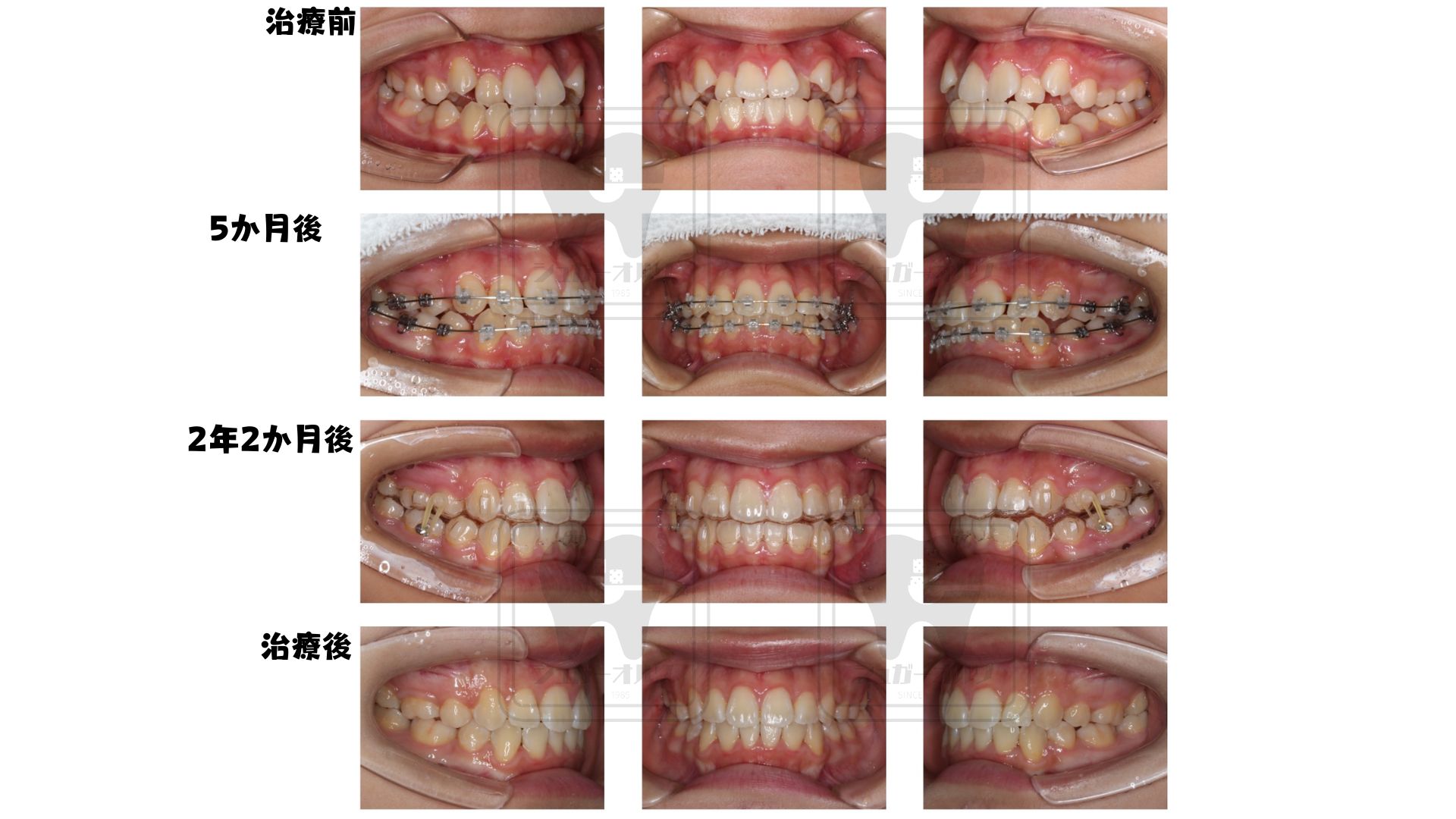 表側ワイヤ矯正・インビザライン矯正（抜歯症例）