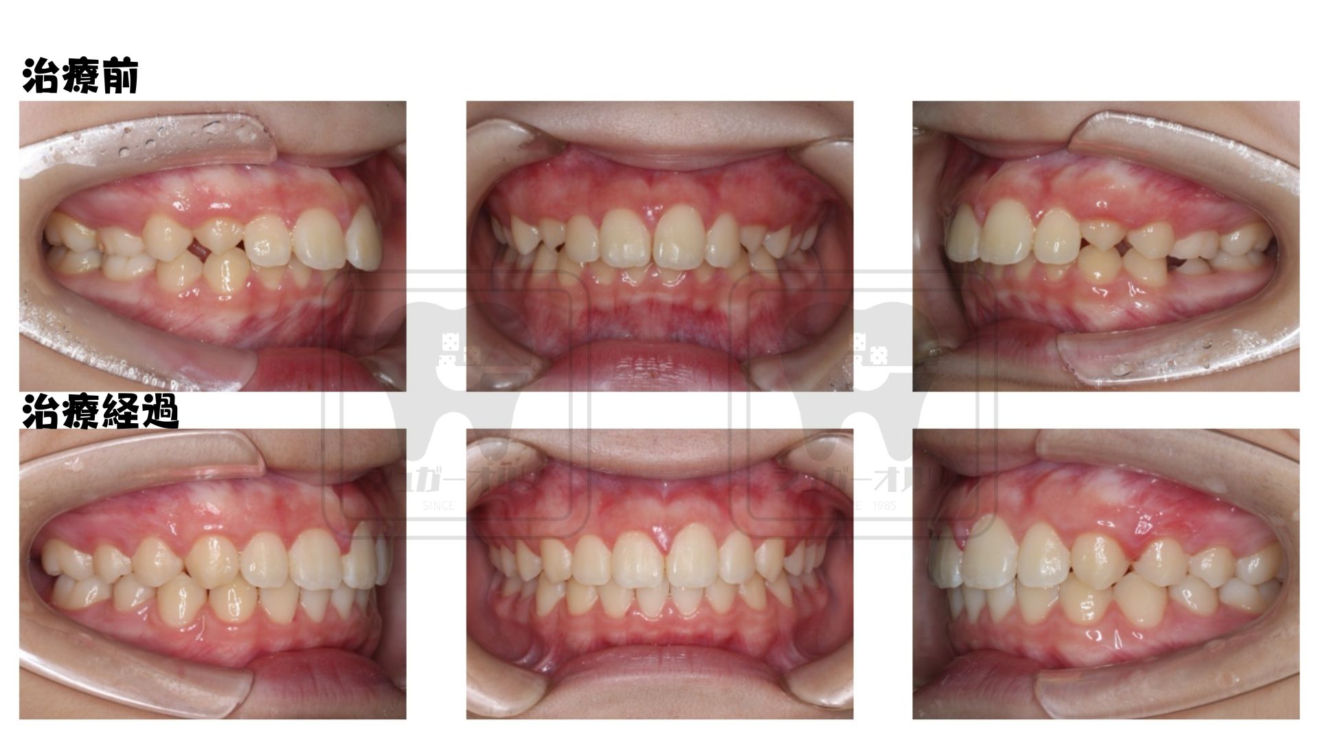 乳歯列期・小児矯正