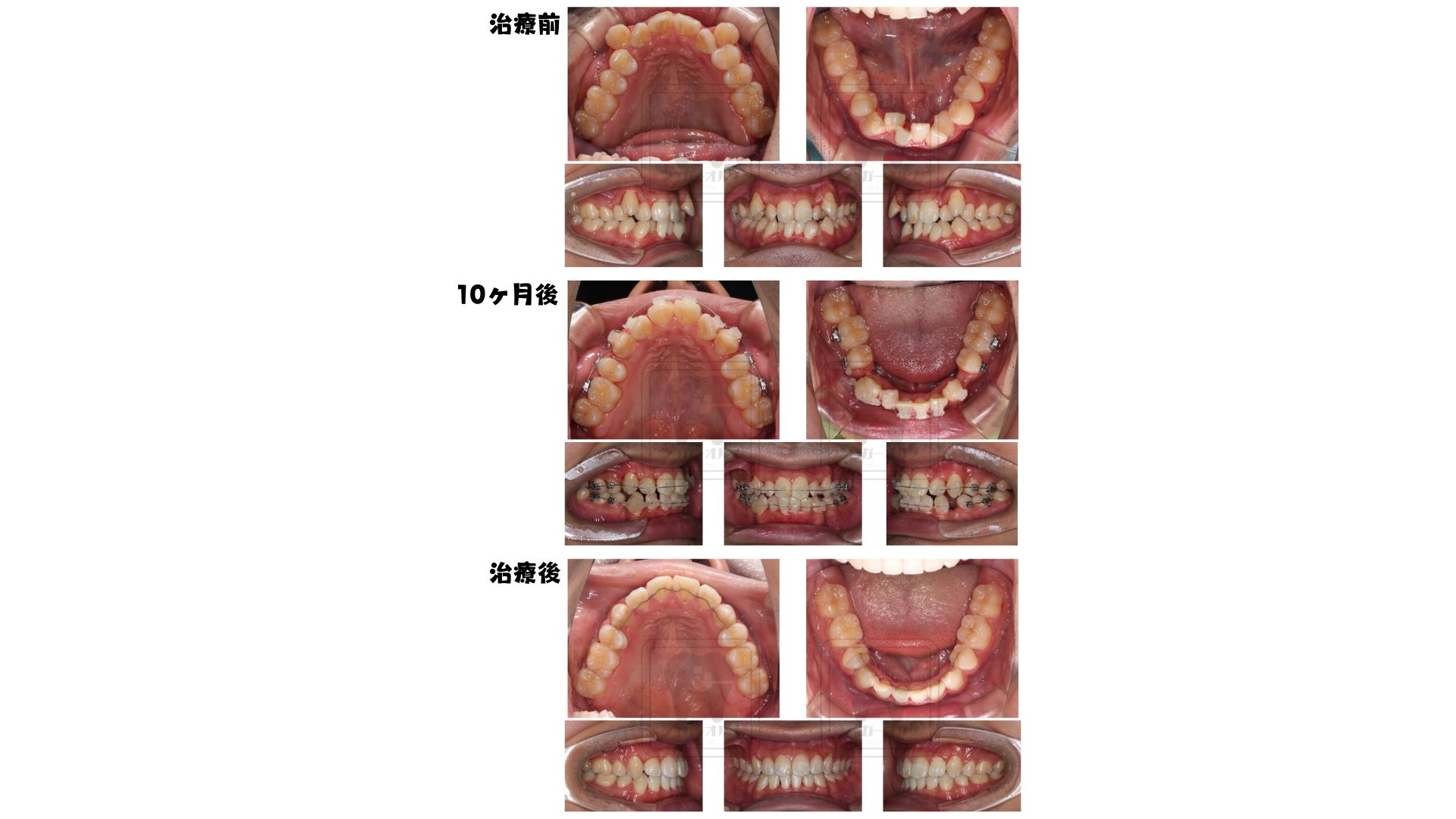 表側ワイヤー矯正（抜歯症例）