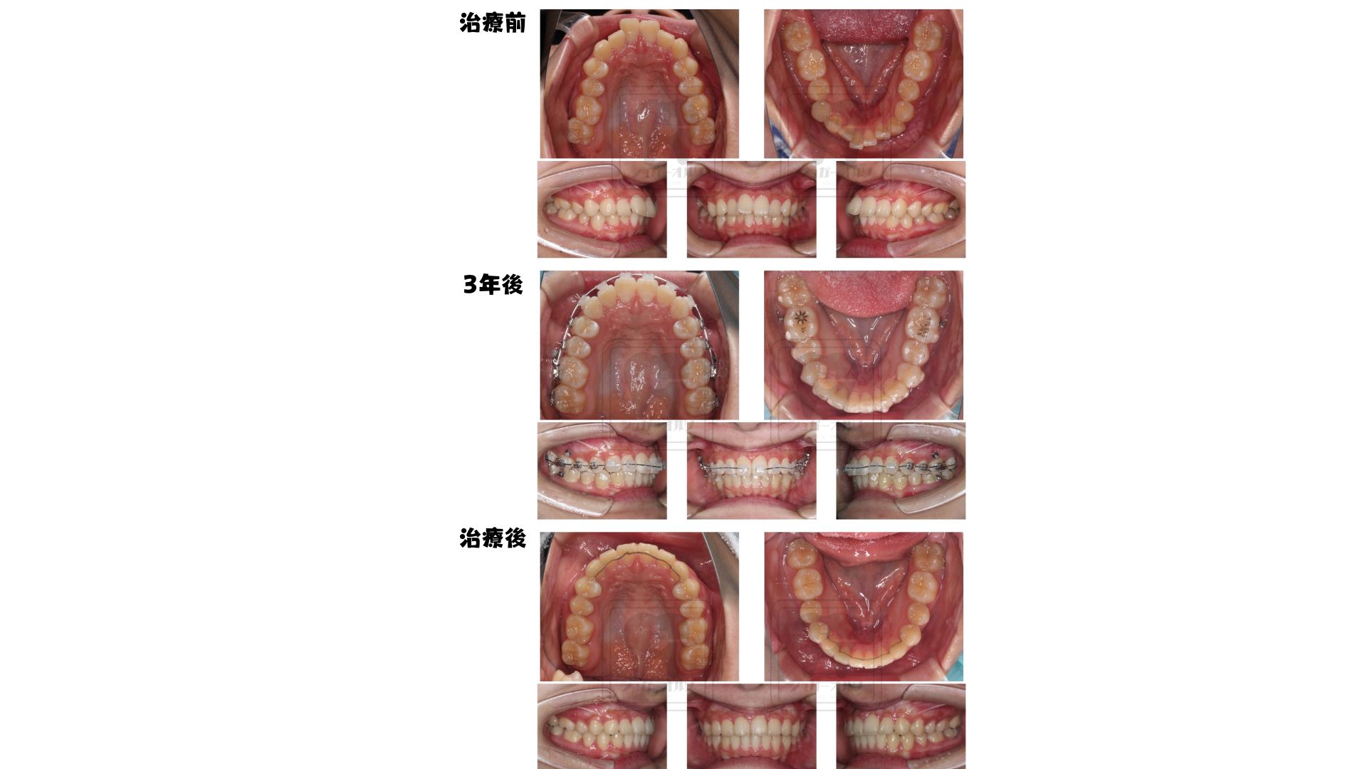 マウスピース矯正・ワイヤー矯正（非抜歯症例）